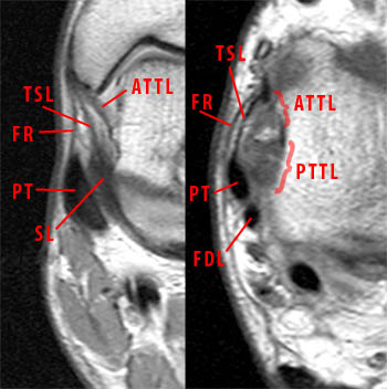 Imaging RM Del Legamento Deltoideo | Radiologia Ortopedica